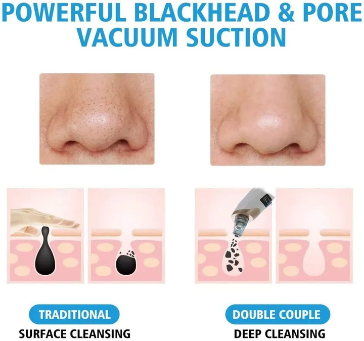 Mihraaj | Multifunction Blackhead Remover – 5-in-1 Deep Pore Cleansing Mihraaj